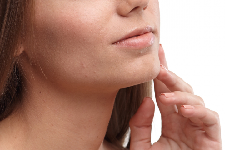 クレーター・ニキビ跡