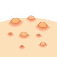 できもの・しこり