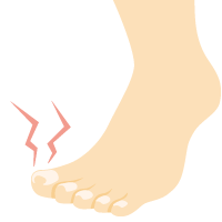 巻き爪・陥入爪